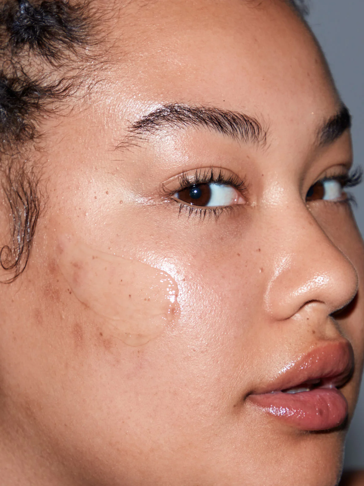 After Acne® - Image 4