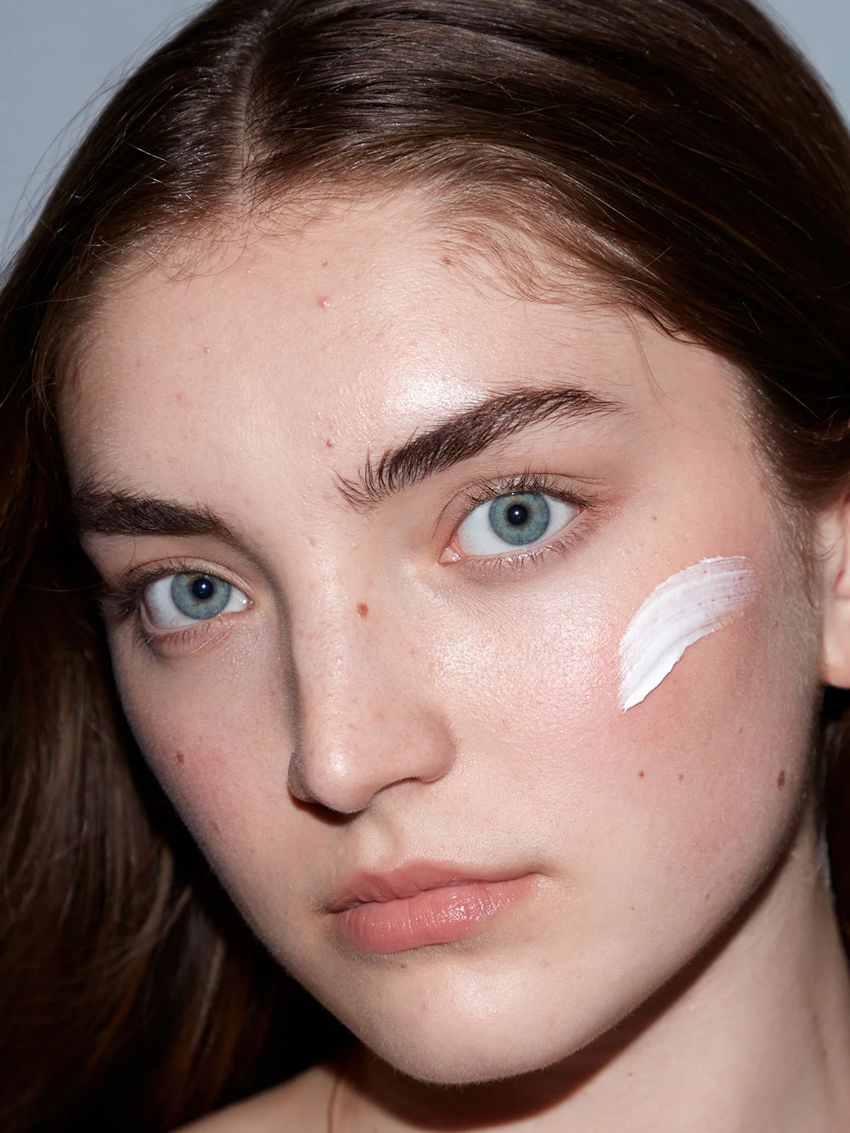 After Acne® - Image 5