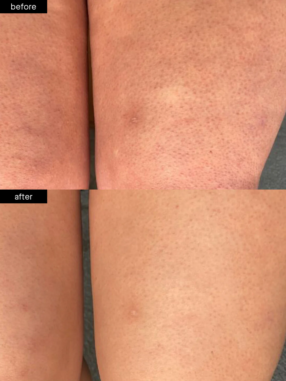 Body Smoothing System - Image 5