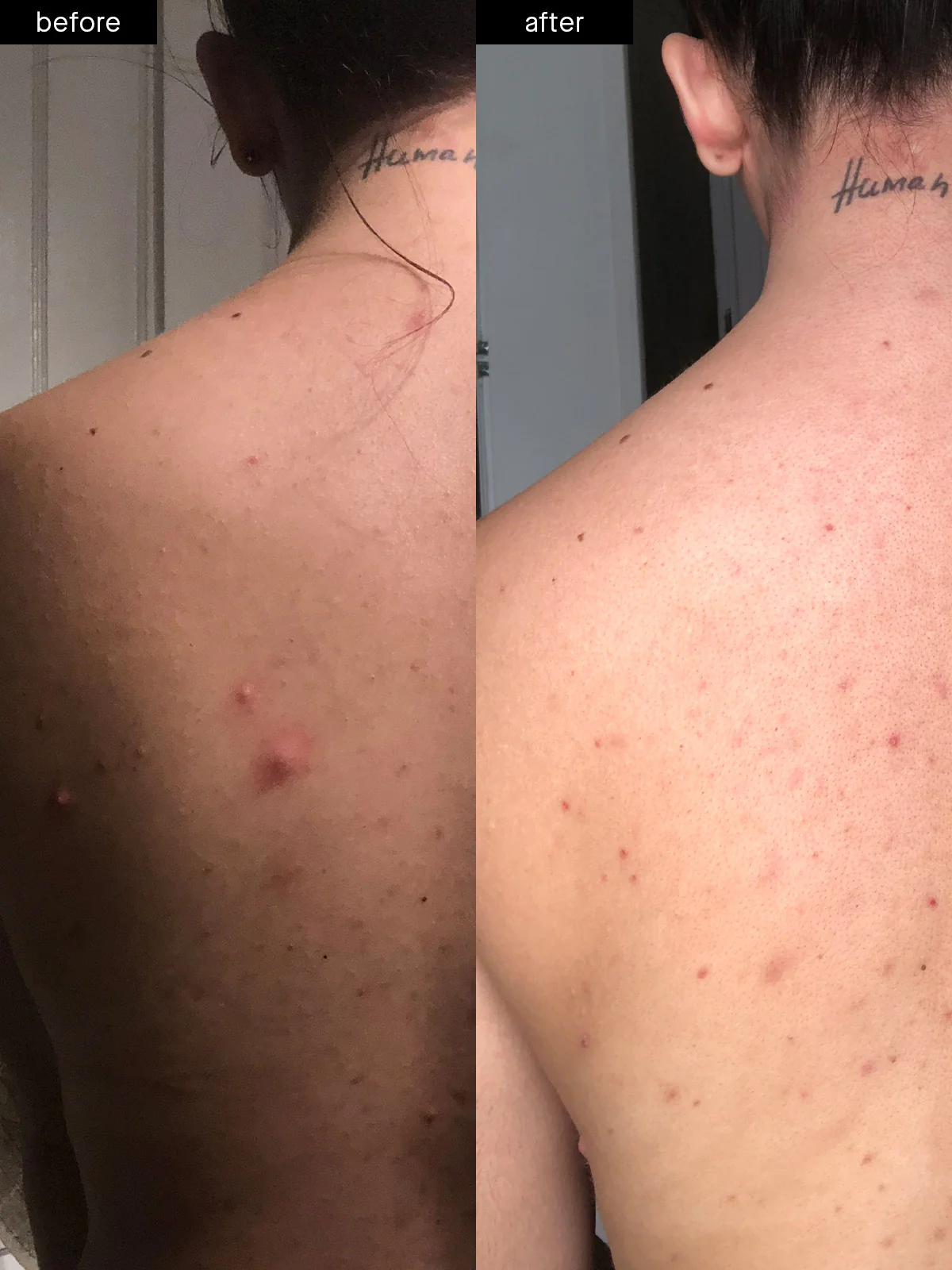 Body Acne System - Image 3
