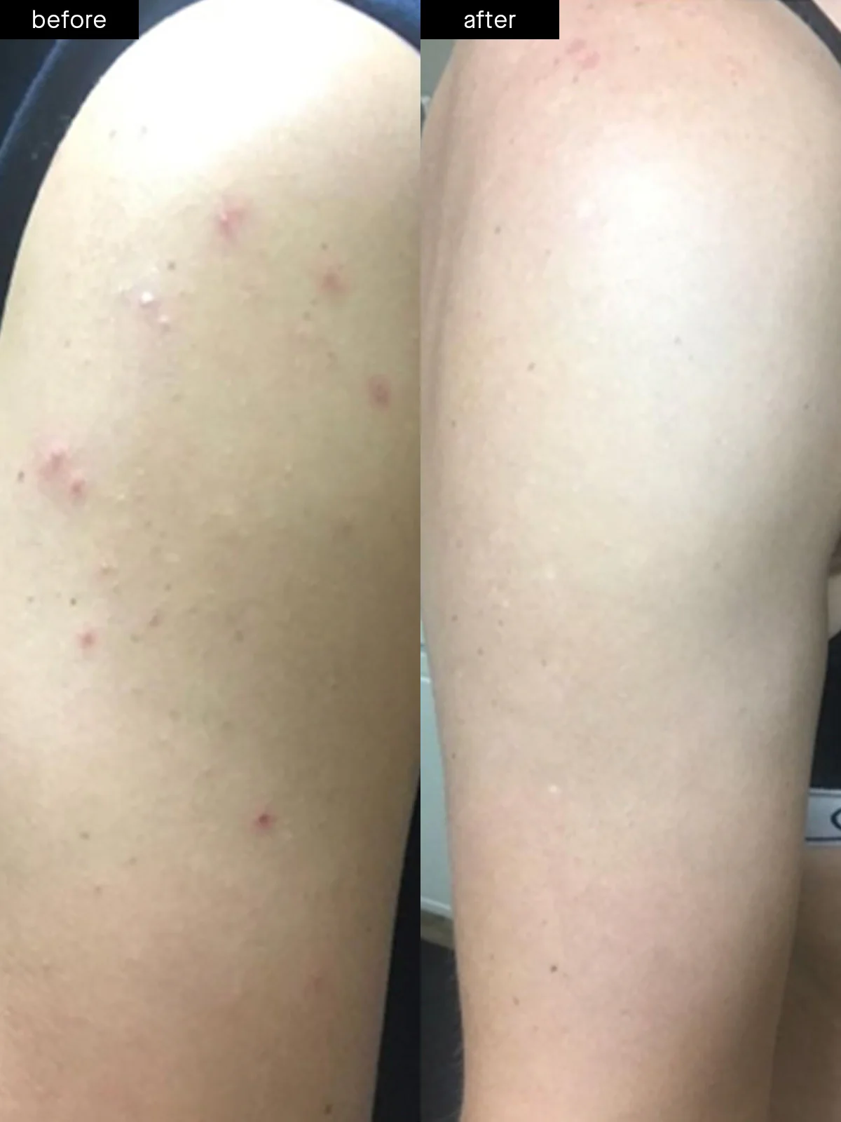 Body Acne System - Image 4